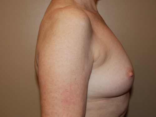 Breast Reconstruction Immediate Implant After Patient 4