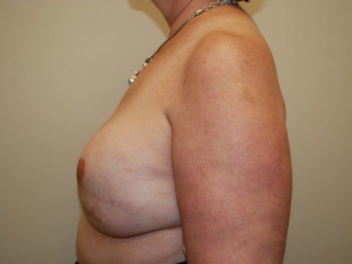 Breast Reconstruction Tissue Expanders After Patient 5