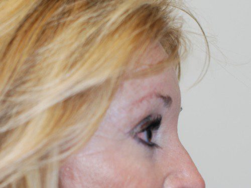 Brow Lift After Patient 5