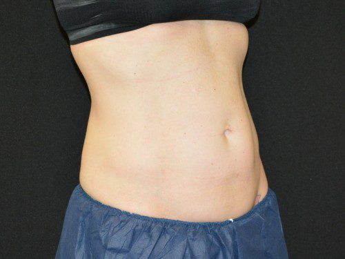 Coolsculpting After Patient 3