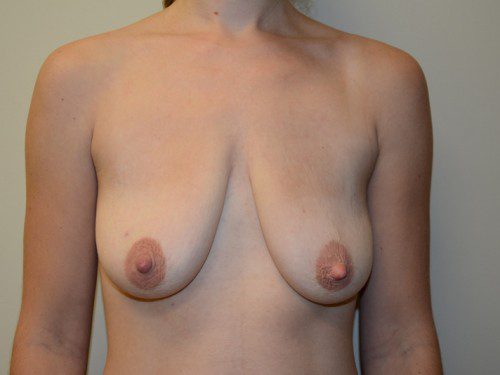 Breast Augmentation w/Lift Before Patient 1