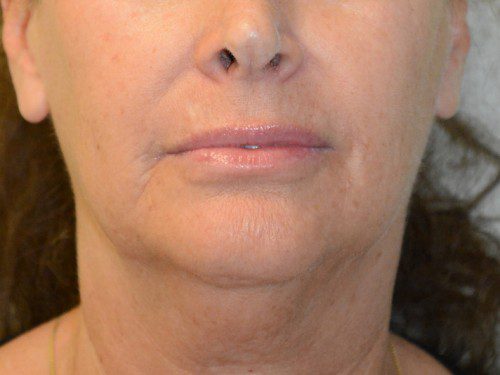 Facelift Before Patient 1