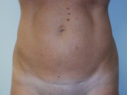 Mini Tummy Tuck Before Patient 1