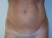 Mini Tummy Tuck Before Patient Thumbnail 1