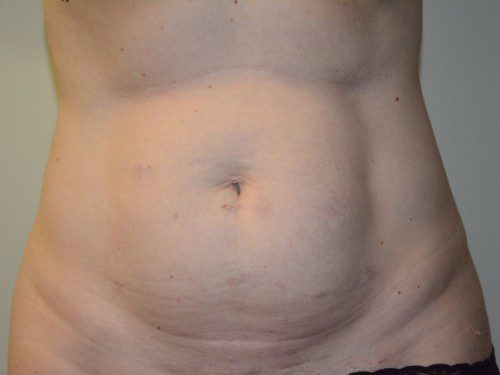 Tummy Tuck Before Patient 1