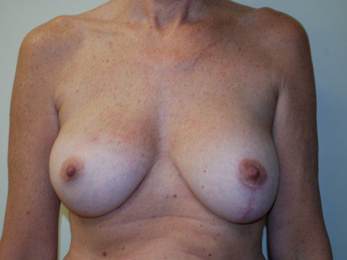Breast Reconstruction Immediate Implant Before Patient 1
