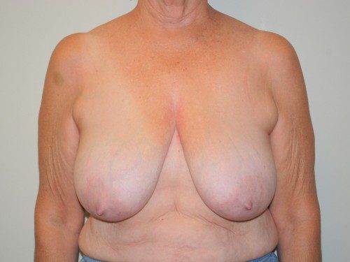 Breast Reduction Before Patient 1