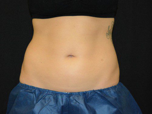 Coolsculpting Before Patient 1