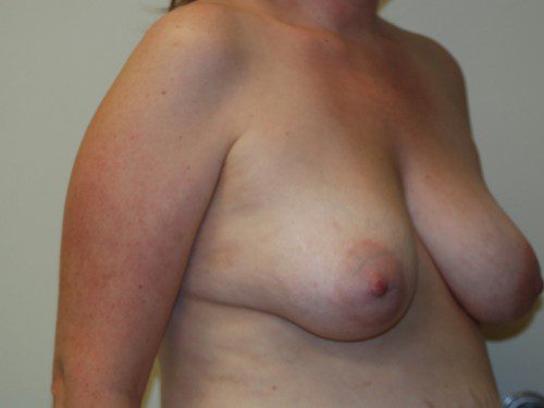 Breast Lift Before Patient 2