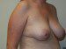 Breast Lift Before Patient Thumbnail 2