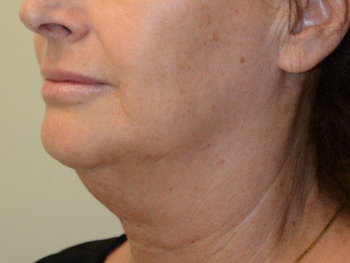 Facelift Before Patient 2