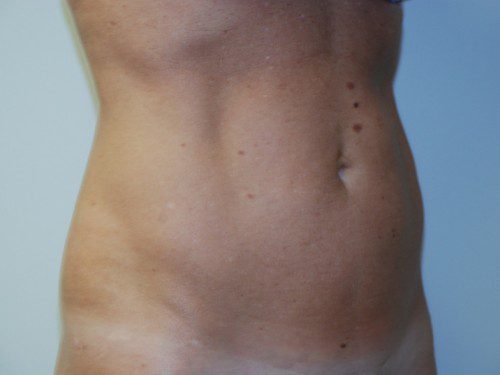 Mini Tummy Tuck Before Patient 2