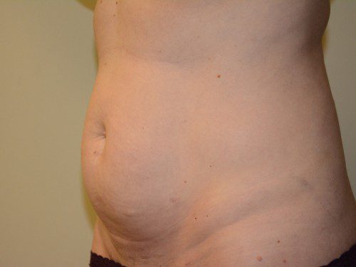 Tummy Tuck Before Patient 3