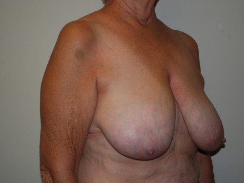 Breast Reduction Before Patient 2