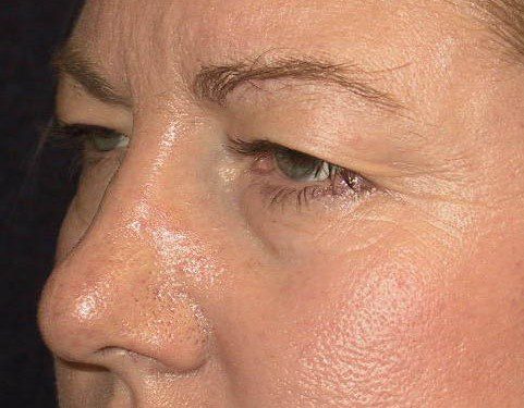 Brow Lift Before Patient 2