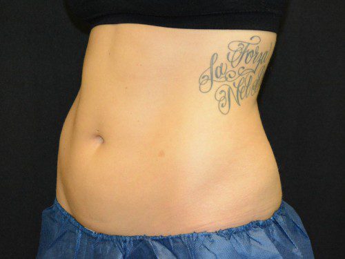 Coolsculpting Before Patient 2