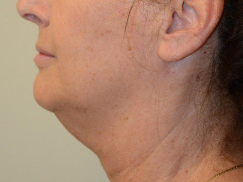 Facelift Before Patient 4