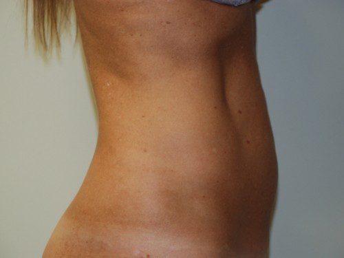 Mini Tummy Tuck Before Patient 4