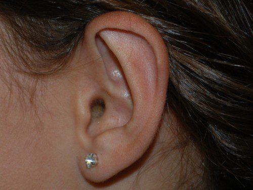 Prominent Ear Surgery After Patient 3