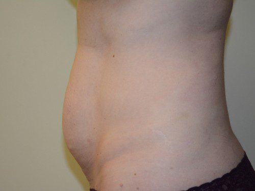 Tummy Tuck Before Patient 4