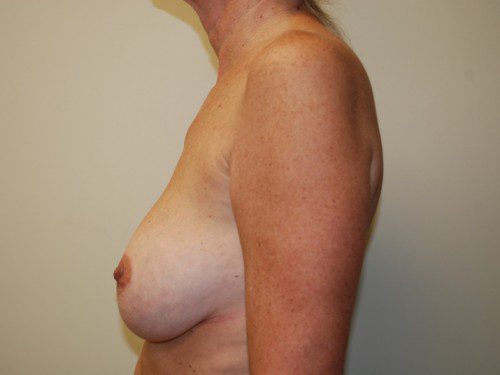 Breast Reconstruction Immediate Implant Before Patient 4