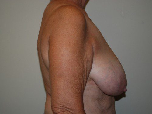 Breast Reduction Before Patient 4