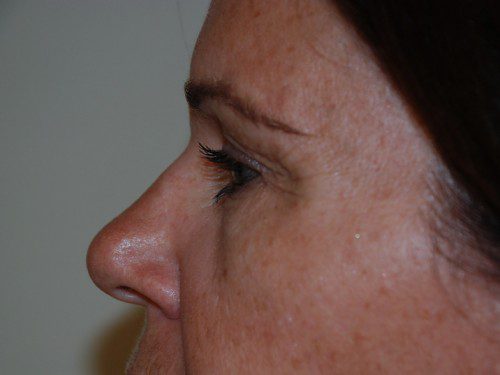 Eyelid Surgery Before Patient 4