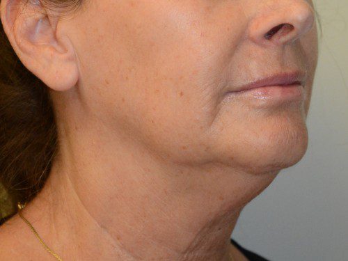 Facelift Before Patient 3