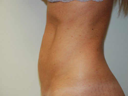 Mini Tummy Tuck Before Patient 5