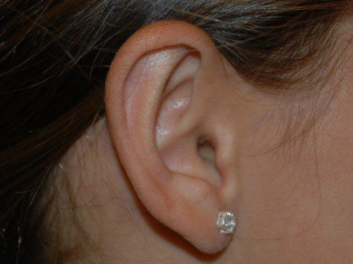 Prominent Ear Surgery After Patient 4