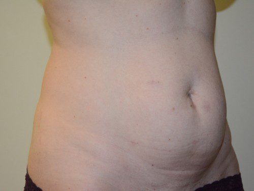 Tummy Tuck Before Patient 2