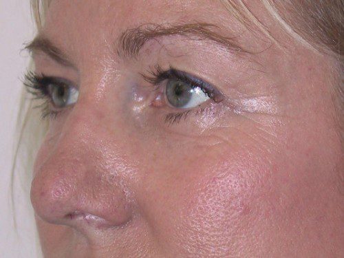 Brow Lift After Patient 2