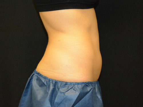 Coolsculpting Before Patient 4