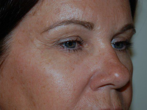 Eyelid Surgery Before Patient 3