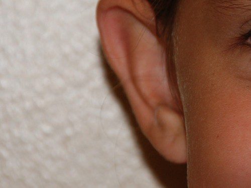 Prominent Ear Surgery Before Patient 2