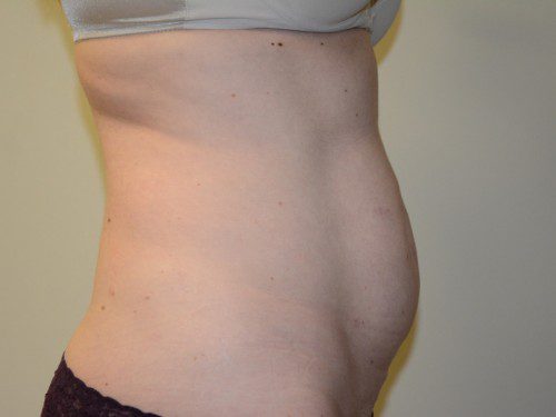 Tummy Tuck Before Patient 5