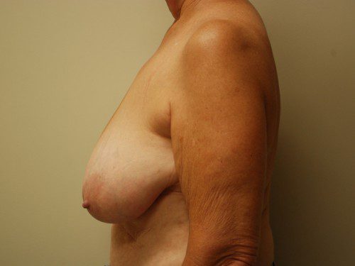 Breast Reduction Before Patient 5