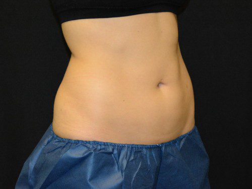 Coolsculpting Before Patient 3