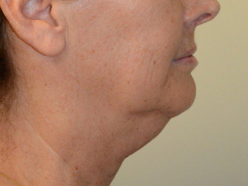 Facelift Before Patient 5