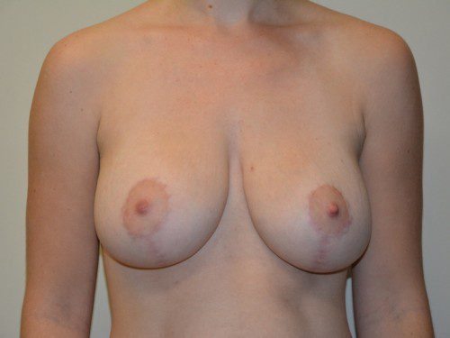 Breast Augmentation w/Lift After Patient 1