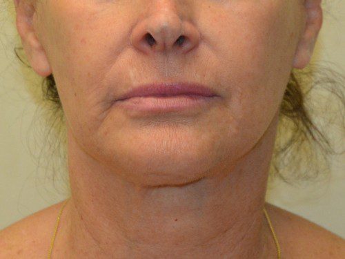 Facelift After Patient 1