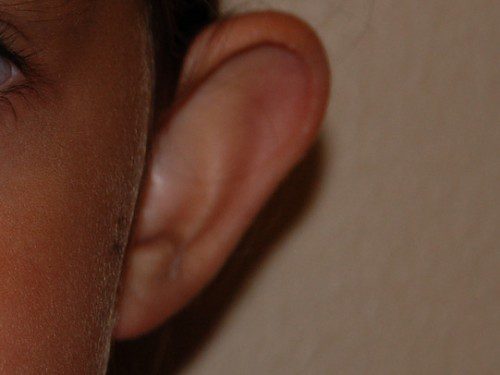 Prominent Ear Surgery Before Patient 1