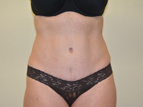 Tummy Tuck After Patient 1