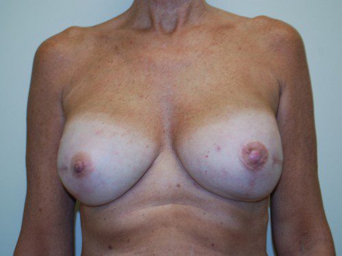 Breast Reconstruction Immediate Implant After Patient 1