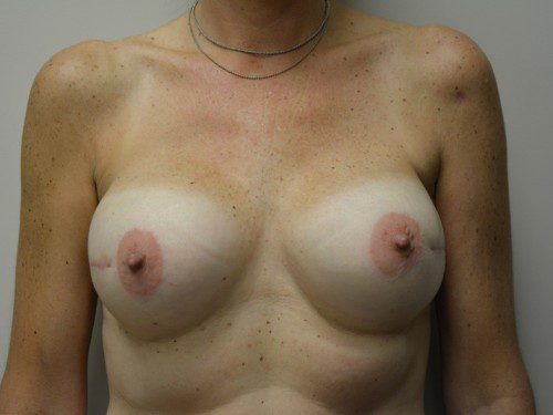 Breast Reconstruction Tissue Expanders After Patient 1