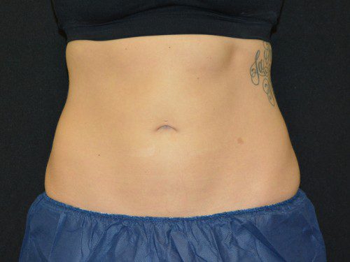 Coolsculpting After Patient 1