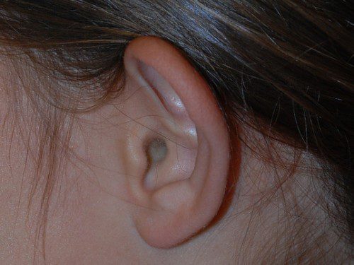 Prominent Ear Surgery Before Patient 3