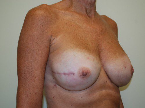 Breast Reconstruction Immediate Implant After Patient 3