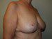 Breast Reduction After Patient Thumbnail 2