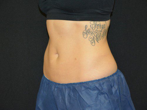 Coolsculpting After Patient 2